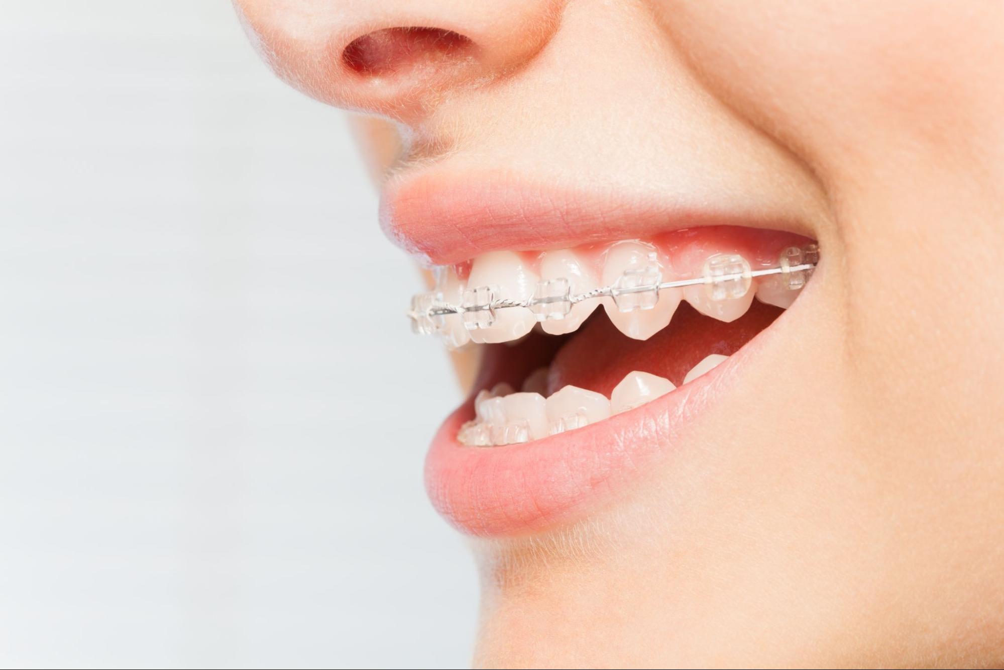 4 Reasons to Get Adult Braces